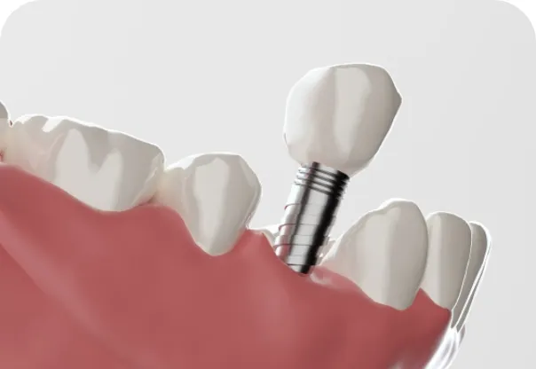 インプラント治療